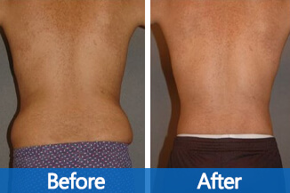 prenasContour® Light PLUS Treatment Before & After